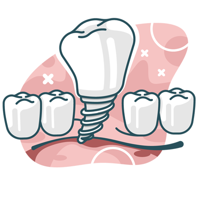 illustration of a dental implant