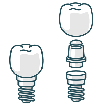 Two dental implants
