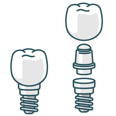 Dental implant illustration