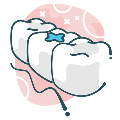 Illustration of dental filling