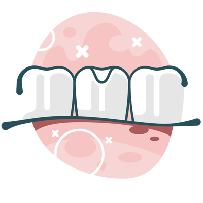 Illustration of dental filling