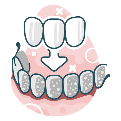 Illustration of veneers