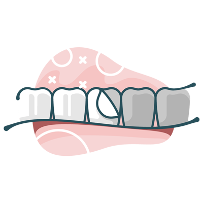 illustration of dental veneers