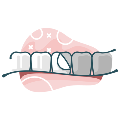 illustration of veneers