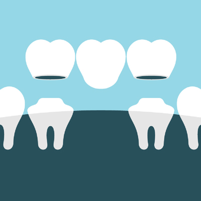 Dental crowns and bridges illustration