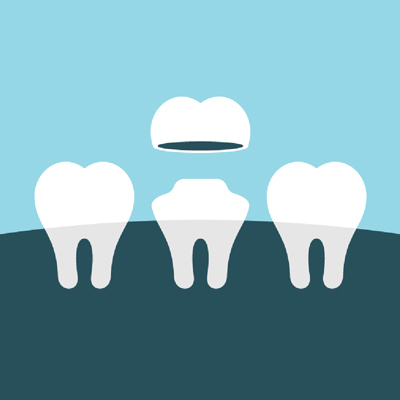 Illustration of Dental Crowns