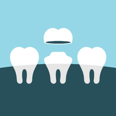 graphic of dental crown