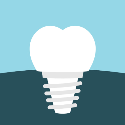 Dental Implant illustration