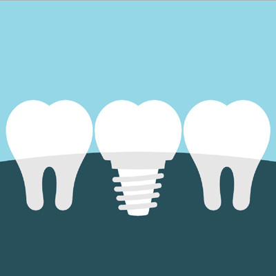 Dental Implant illustration