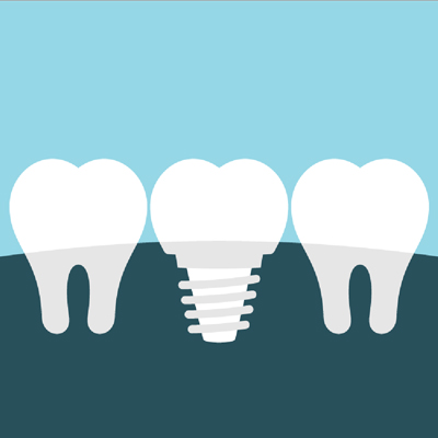 Illustration of a tooth replacement