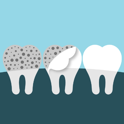 Dental veneers illustration