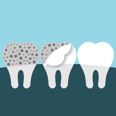 illustration of veneers