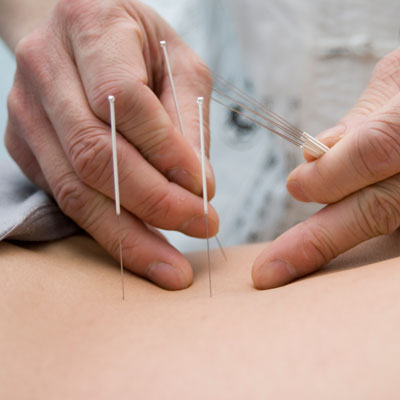 Applying acupuncture needles to back
