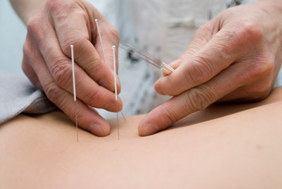 Doctor applying acupunture needles