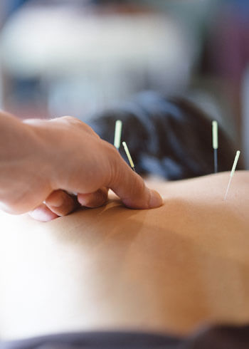 Acupuncture needles in back