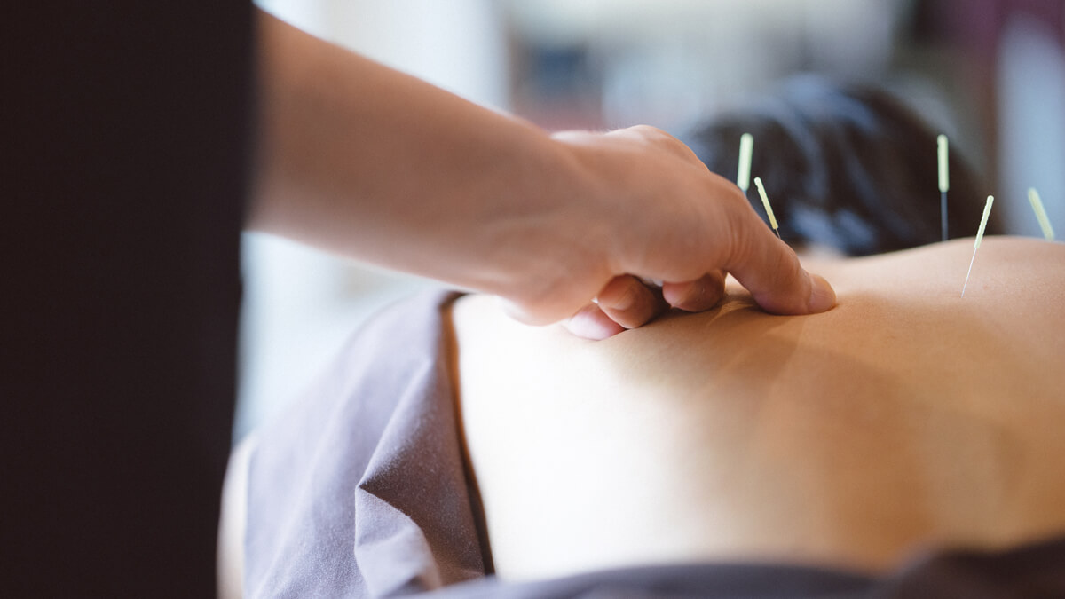 Applying acupuncture needles on back