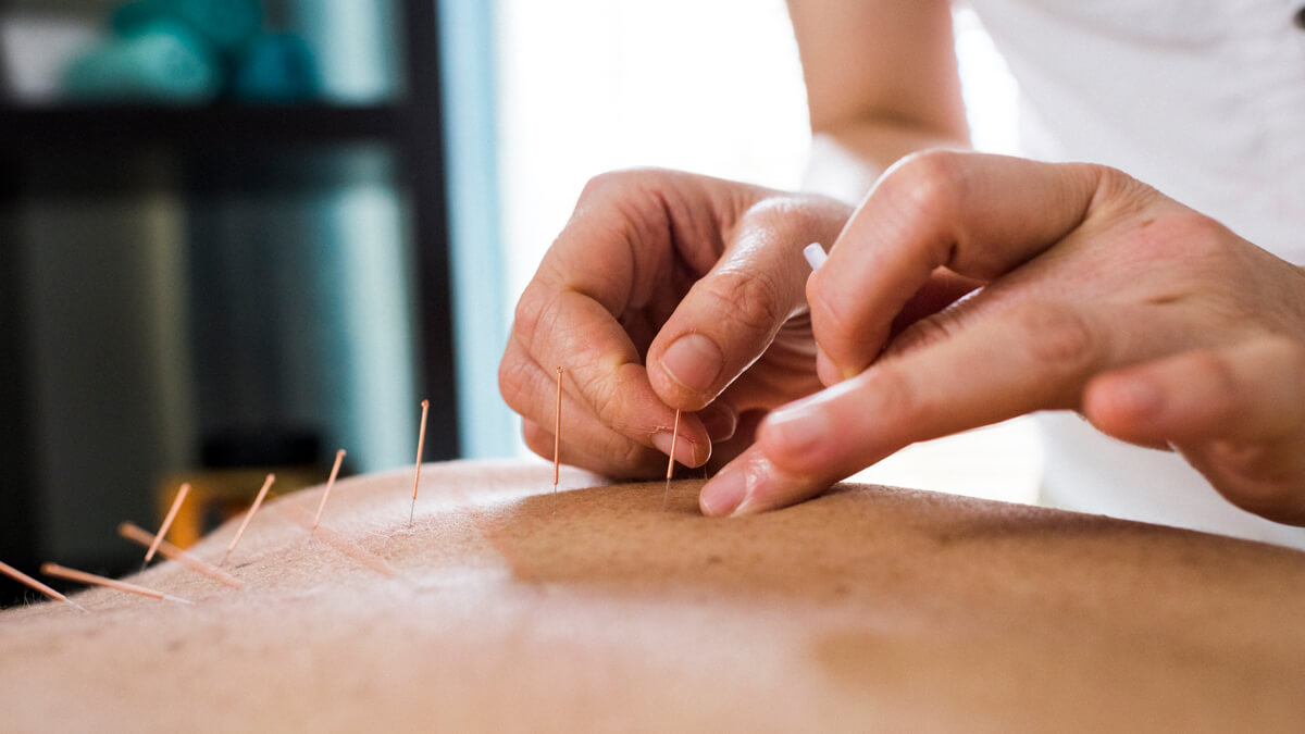 Applying acupuncture needles