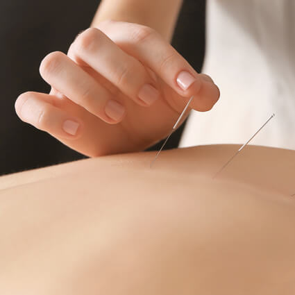 Acupuncture needles applied to upper-back
