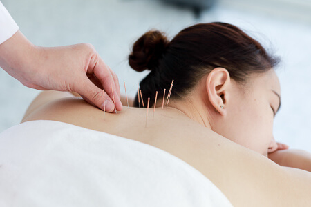 Patient treated with acupuncture