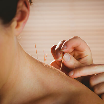 Acupuncture needles on shoulder