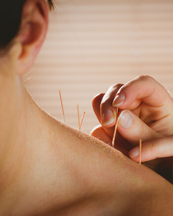 Acupuncture patient