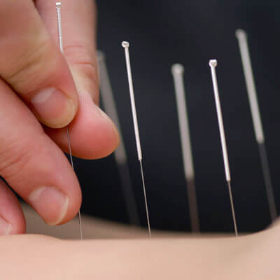 Acupuncture needles being inserted into the skin