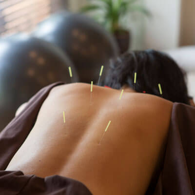 patient with acupuncture needles in back