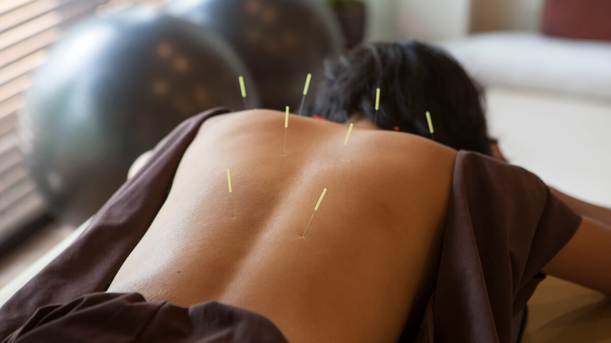 Acupuncture needles on back