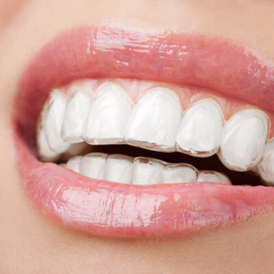 closeup smile of teeth with Invisalign aligner inserted