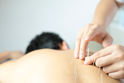 applying acupuncture needle