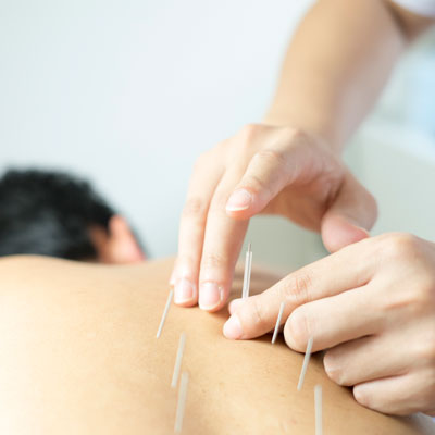 applying acupuncture needles on male patients back
