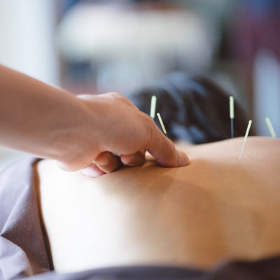 Female patient back acupuncture