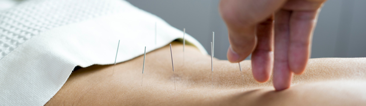 applying acupunture needles in lower back