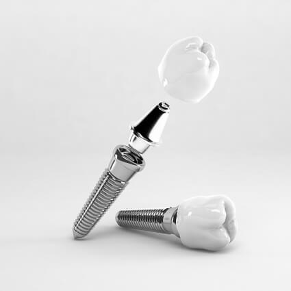 Dental implant model