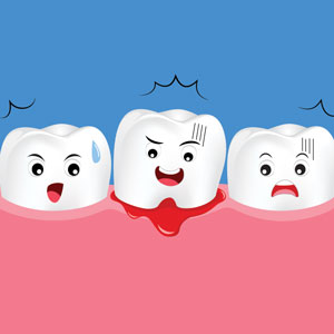 Illustration of bleeding gums