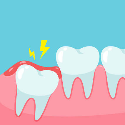 wisdom tooth illustration