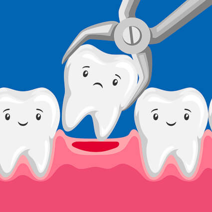 Tooth extraction illustration