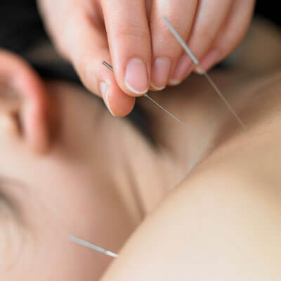 closeup of acupuncture needles on patients shoulder