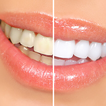 stained teeth before and after comparison