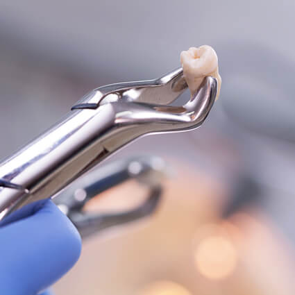 closeup of removed tooth in pliers