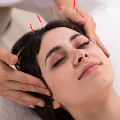 woman with facial acupuncture needles