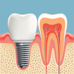 Root of a tooth before extraction