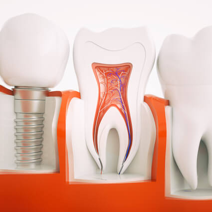 Dental Implants