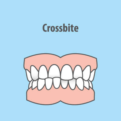 crossbite illustration