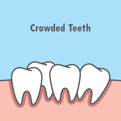crowded teeth illustration