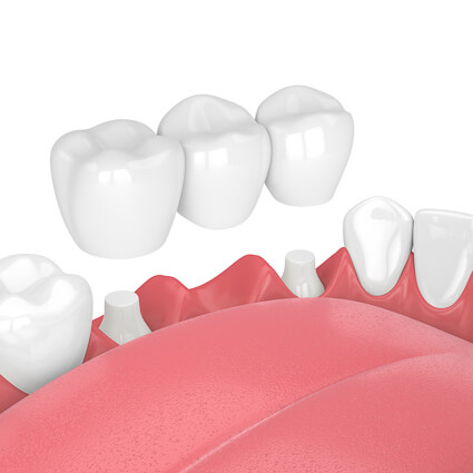 illustration of a dental bridge