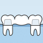 Illustration of dental crown