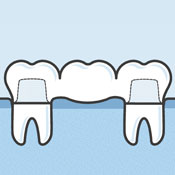 Illustration of dental bridge