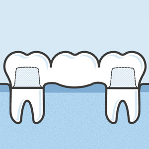 illustration of dental bridges