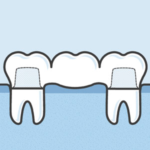 Dental bridge illustration